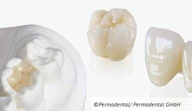 Auswahl der richtigen Kronen und Brücken und deren Befestigung