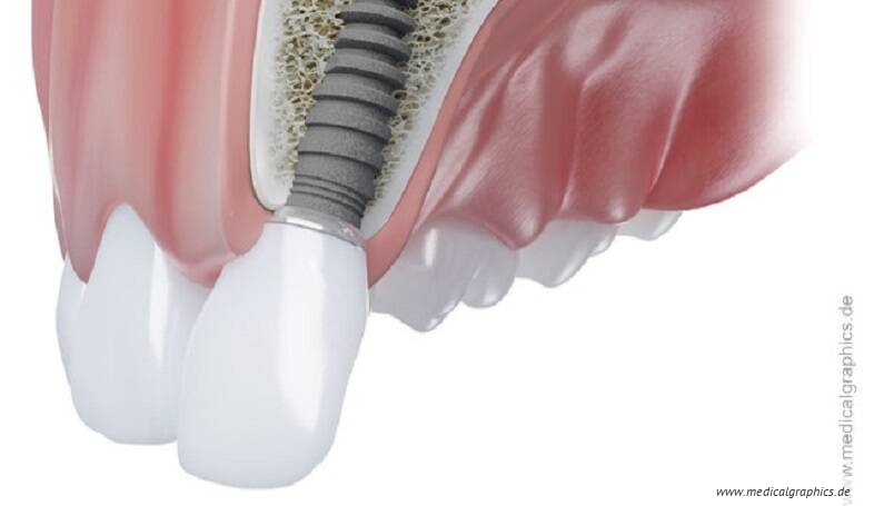 eLearning: Abrechnung der implantologischen Leistungen für Einsteiger