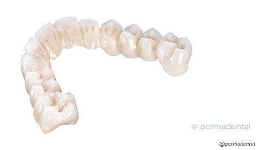 Metallfreie Versorgung - Kronen, Brücken oder Inlay