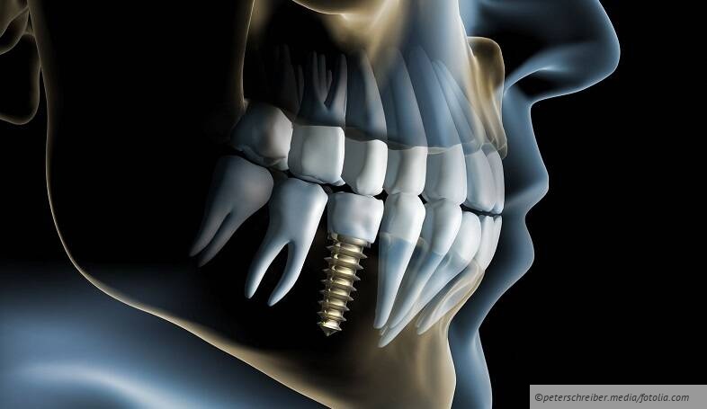 Abrechnungen von implantatgetragenem Zahnersatz (Suprakonstruktionen)